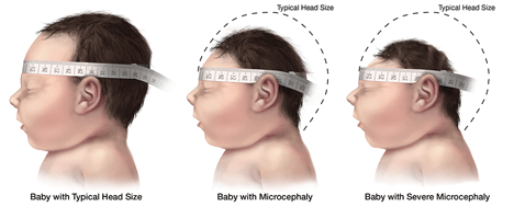 Microcephaly measuring